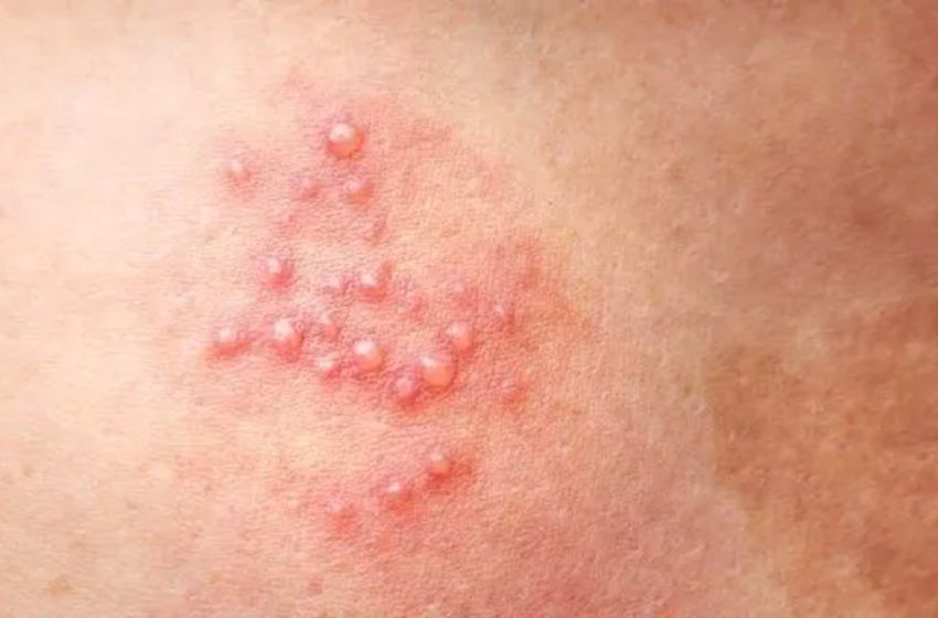  Puebla lidera preocupante estadística nacional: ¡El primer lugar en casos de herpes genital