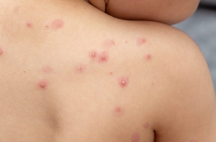  Descarta Salud casos en Puebla de viruela símica alertada por la OMS