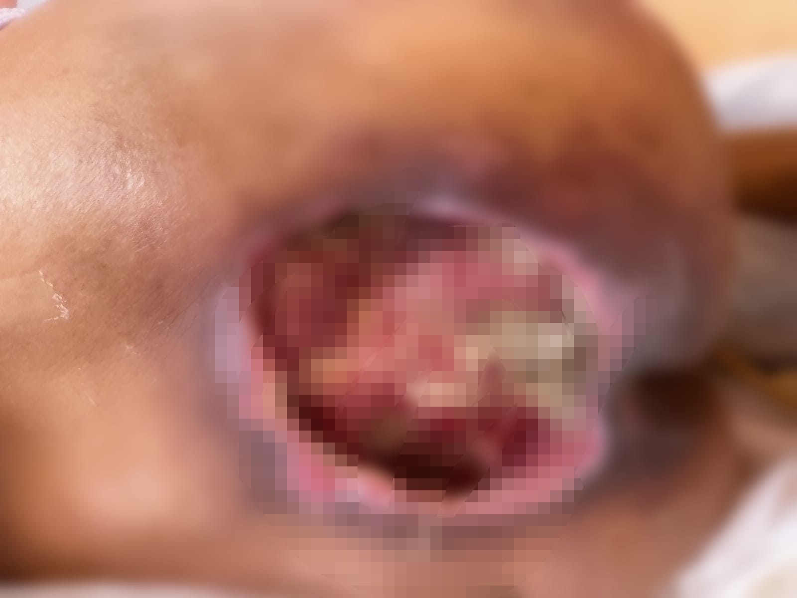 Paciente ingresa a hospital de Atlixco y sale con gusanos en las heridas