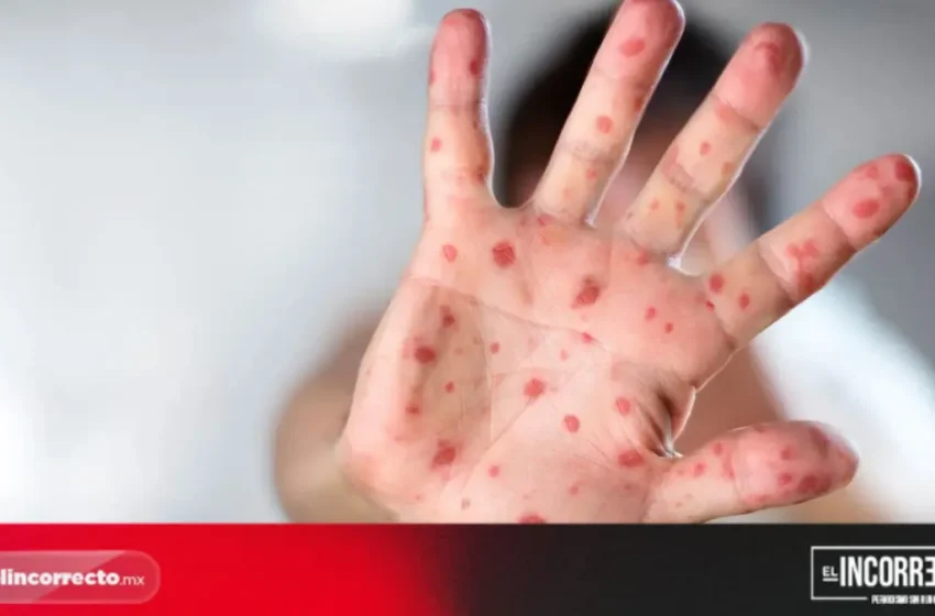 Van 73 casos confirmados de Sarampión en Puebla