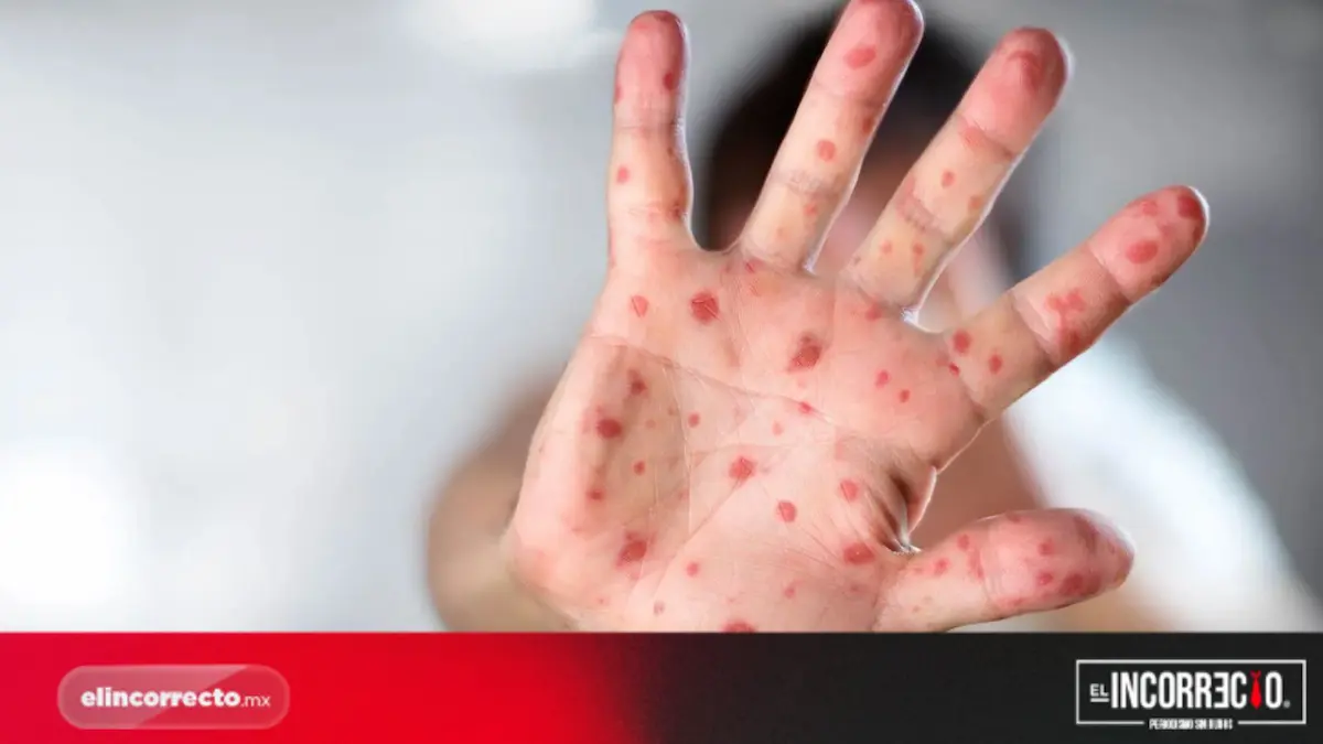 Van 73 casos confirmados de Sarampión en Puebla