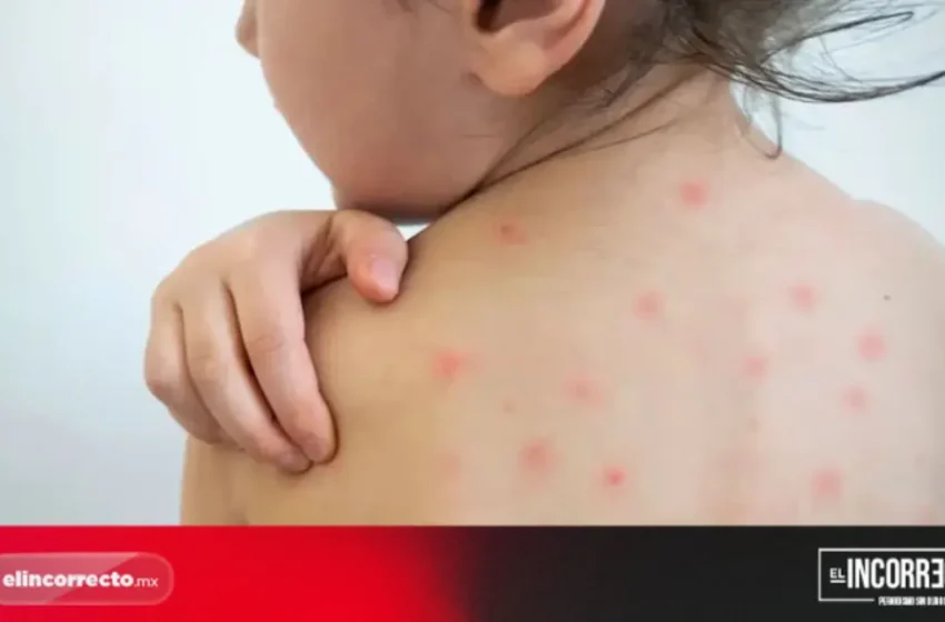  Reporta Salud 66 casos confirmados de sarampión en Puebla; en cuatro día se registran 13 nuevos