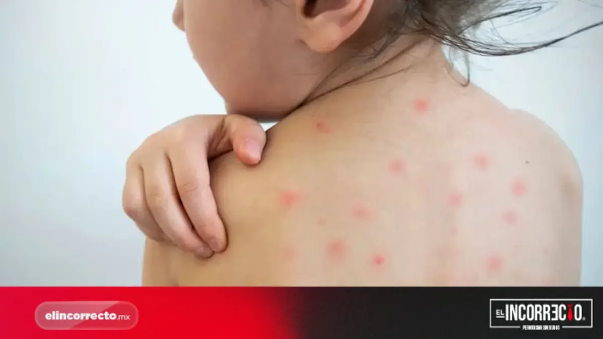 Reporta Salud 66 casos confirmados de sarampión en Puebla; en cuatro día se registran 13 nuevos