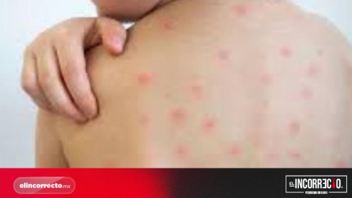 Anuncia Salud jornada de vacunación contra sarampión en paraderos de RUTA